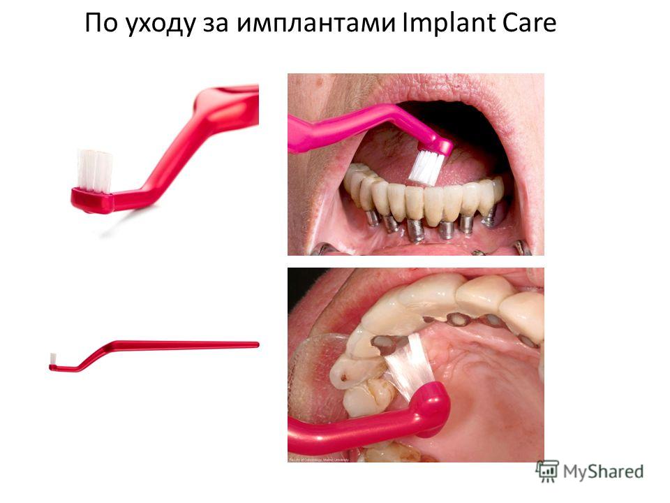 Имплантация зубов: важные моменты
