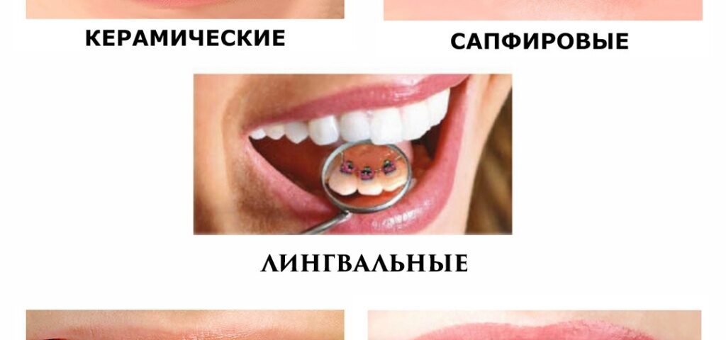 Почему важно выбрать правильные брекеты